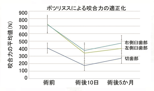 ボツリヌスによる咬合力の適正化