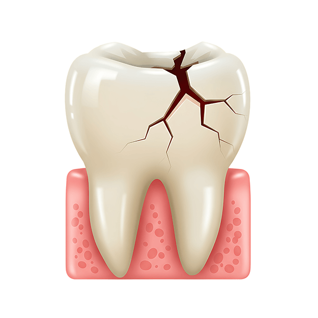 歯のひび割れイラスト