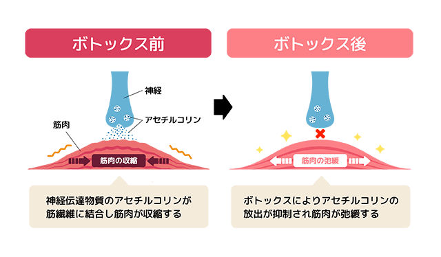 ボトックス前・ボトックス後のイメージイラスト