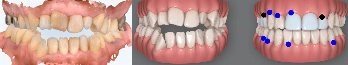 口腔内デジタル画像