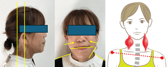 首の角度がやや前傾、ほうれい線・マリオネットラインの左右差、顎の偏位、胸鎖乳突筋の左右差がみられます