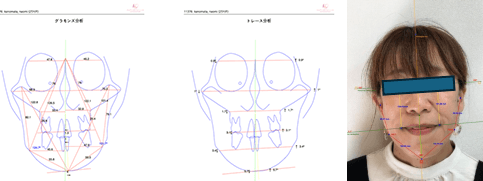 頸椎の角度のズレ、骨の左右差がみられ片噛みが予想されます　ストレートネックなど骨格や頸椎の歪みを診査します<