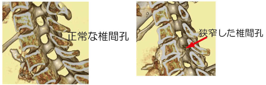 正常な椎間孔、狭搾した椎間孔