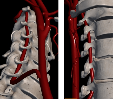 頸椎動脈が圧迫されると脳底動脈への血流が弱くなり、様々な体の症状が現れます