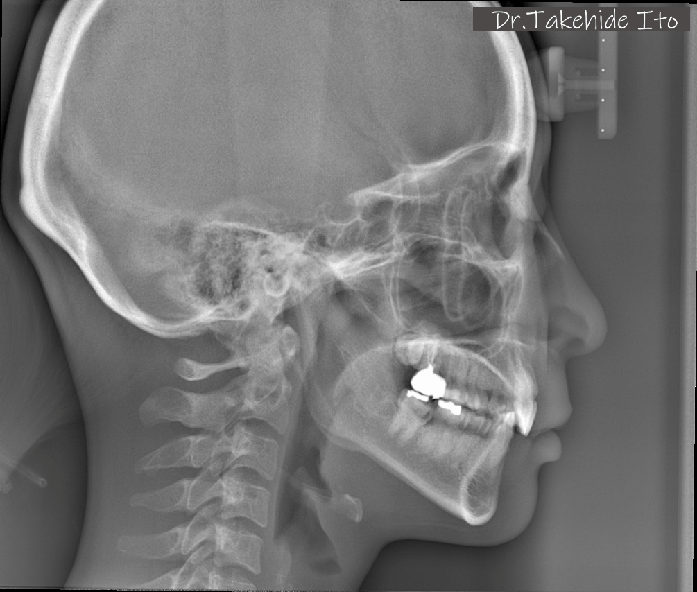 顎位を変えたところと元の顎位の比較