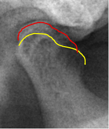 下顎頭のリモデリング