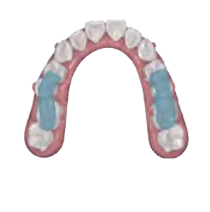 下顎整位咬合スプリント装置