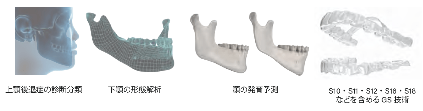 上顎後退症に対するフルサイクル段階的な早期治療計画案