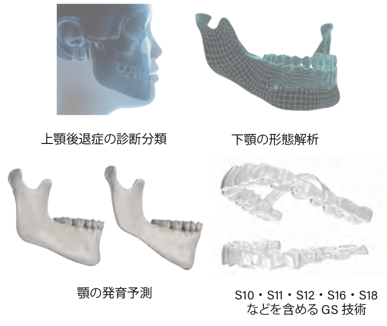 上顎後退症に対するフルサイクル段階的な早期治療計画案