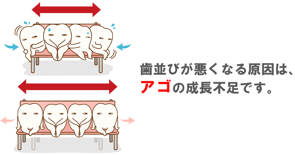 歯並びが悪くなる原因