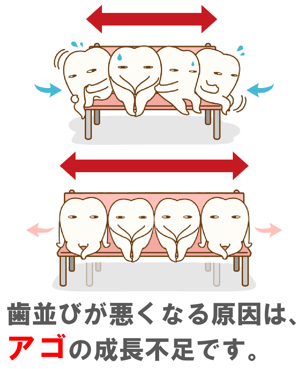 歯並びが悪くなる原因