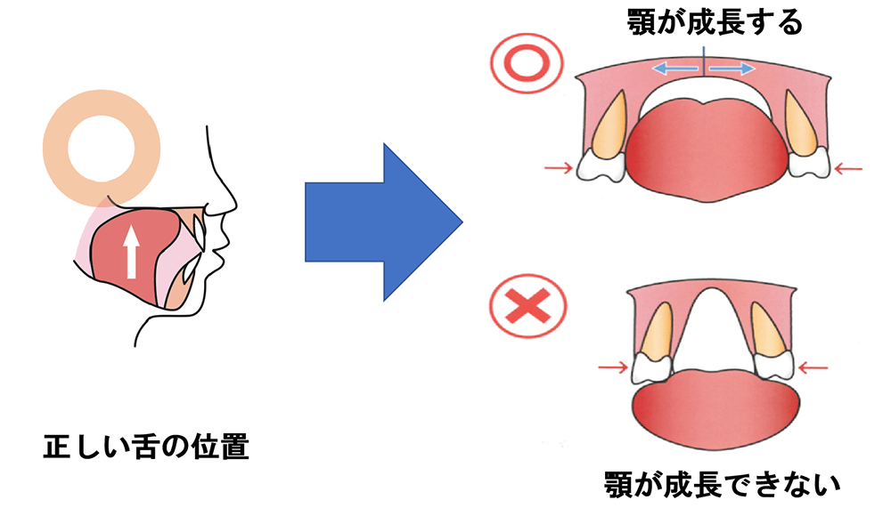 舌が正しい位置にあると