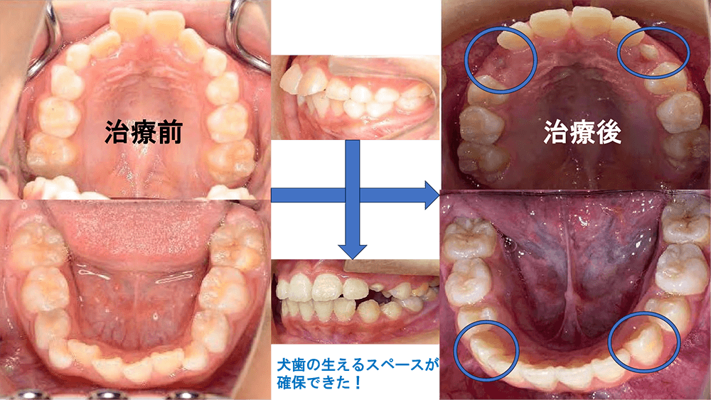 矯正治療前・治療後の写真