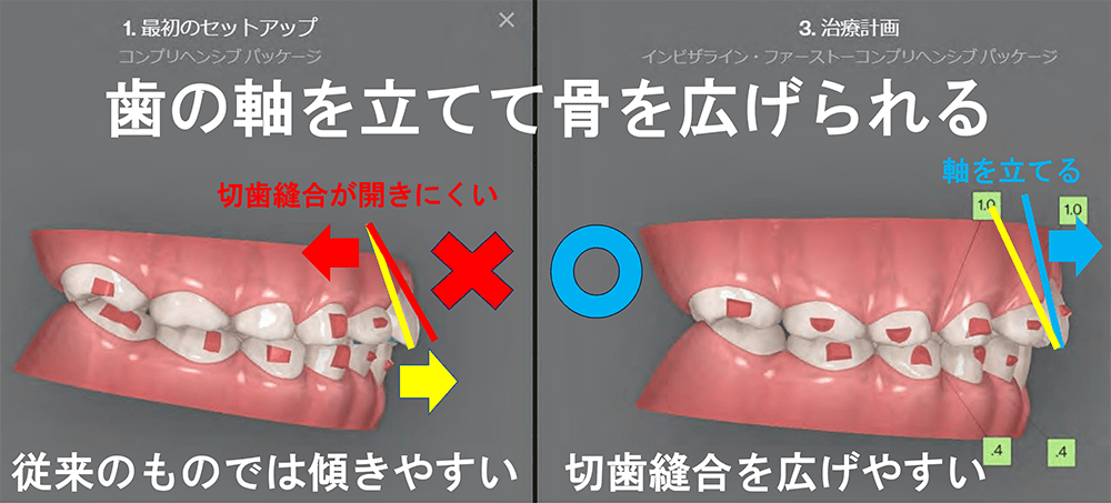 アライナー矯正の良いところ